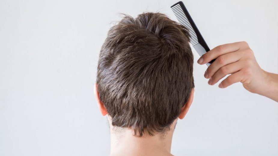 Qué es el pelo ralo en los hombres